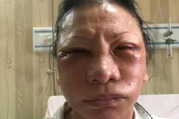 Kabar tersebut menguak setelah beredar foto-foto perempuan yang mirip Ratna dengan wajah penuh luka lebam. Dan ternyata benar, perempuan tersebut adalah Ratna Sarumpaet.